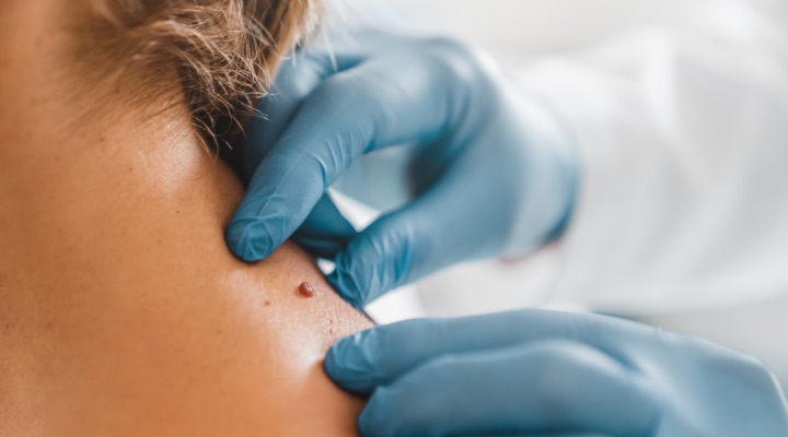 dermatologist inspecting mole on back