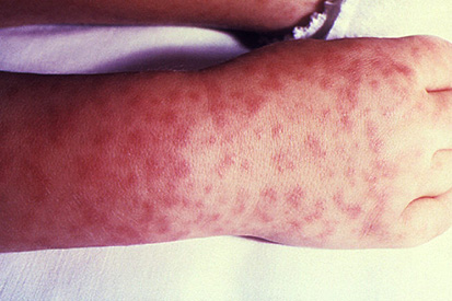 Rocky-Mountain-spotted-fever-1