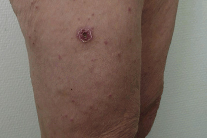 Rocky-Mountain-spotted-fever-3