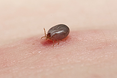 Rocky-Mountain-spotted-fever-2
