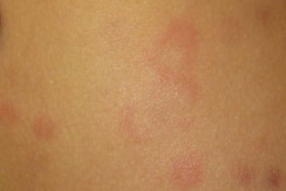 Hives3